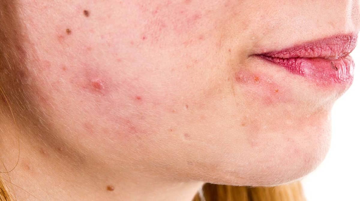 dermatite seborreica o que é causas sintomas e tratamento clínica