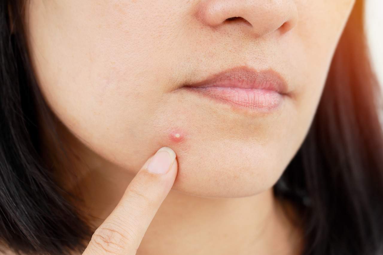 Acne Tudo O Que Voc Precisa Saber Cl nica Dra Juliana Toma