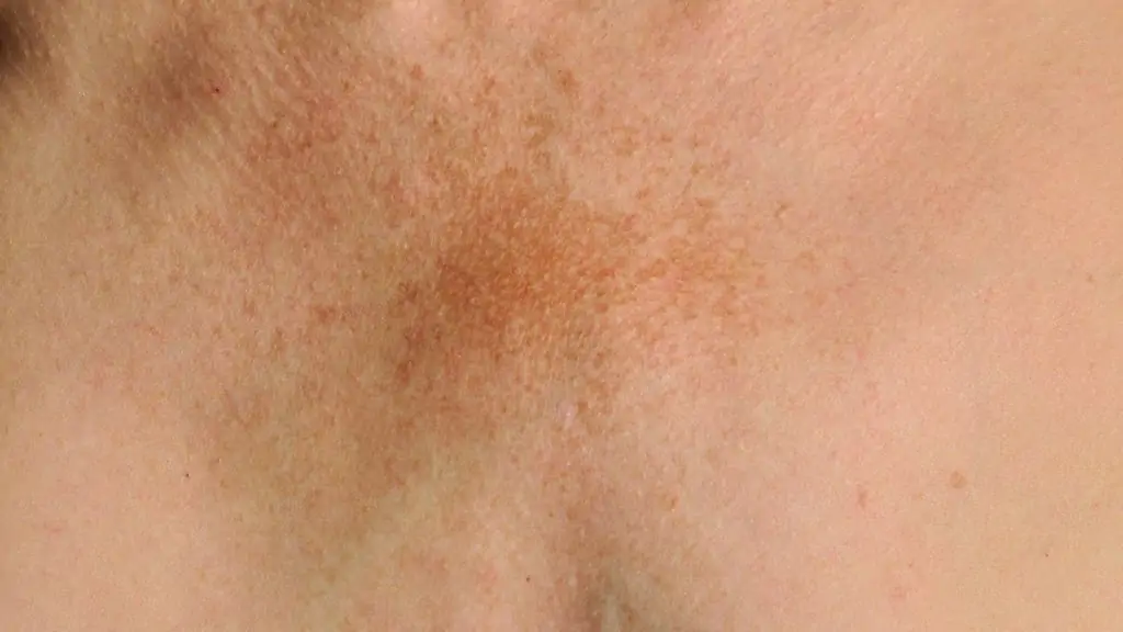 melasma no pescoço